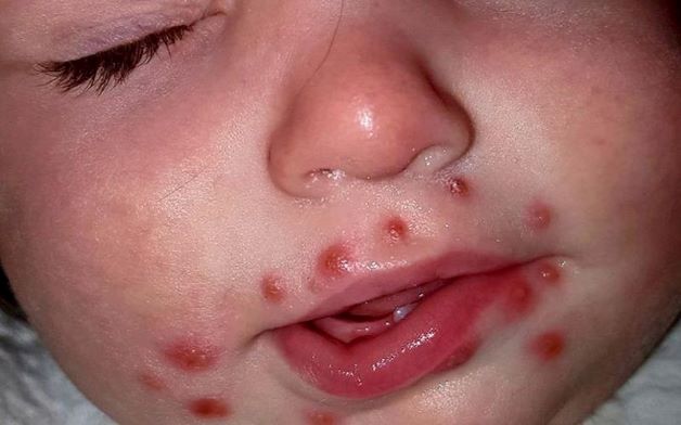 các vết ban đỏ không chỉ xuất hiện ở ngoài da của trẻ mà thậm chí còn phát triển ở trong khoang miệng, lưỡi và sẽ sau đó vỡ ra tạo thành các vết lở loét gây nhiều khó chịu cho trẻ.