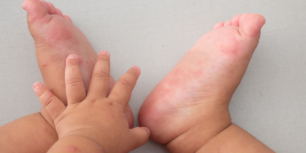 Biểu hiện bệnh tay chân miệng độ 1 ở trẻ em