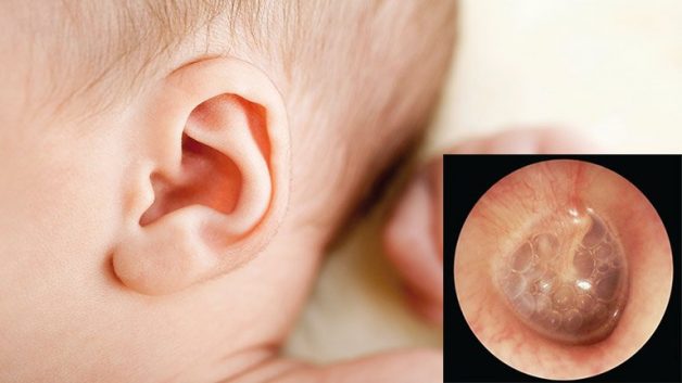 Viêm tai giữa cấp ở trẻ em là căn bệnh thường gặp ở các bé