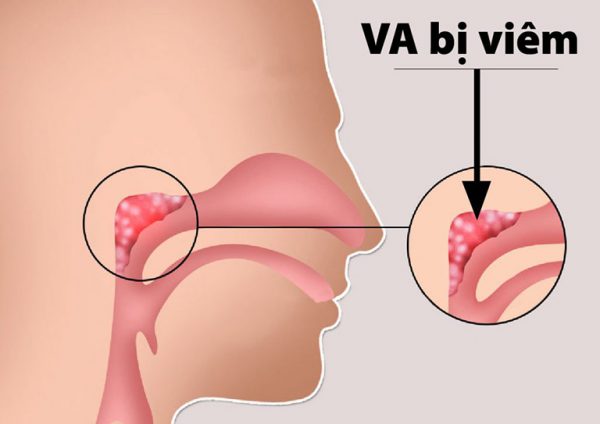 Viêm VA ở trẻ là hiện tượng phổ biến do VA có nhiều khe hốc, là nơi vi khuẩn dễ trú ẩn và phát triển
